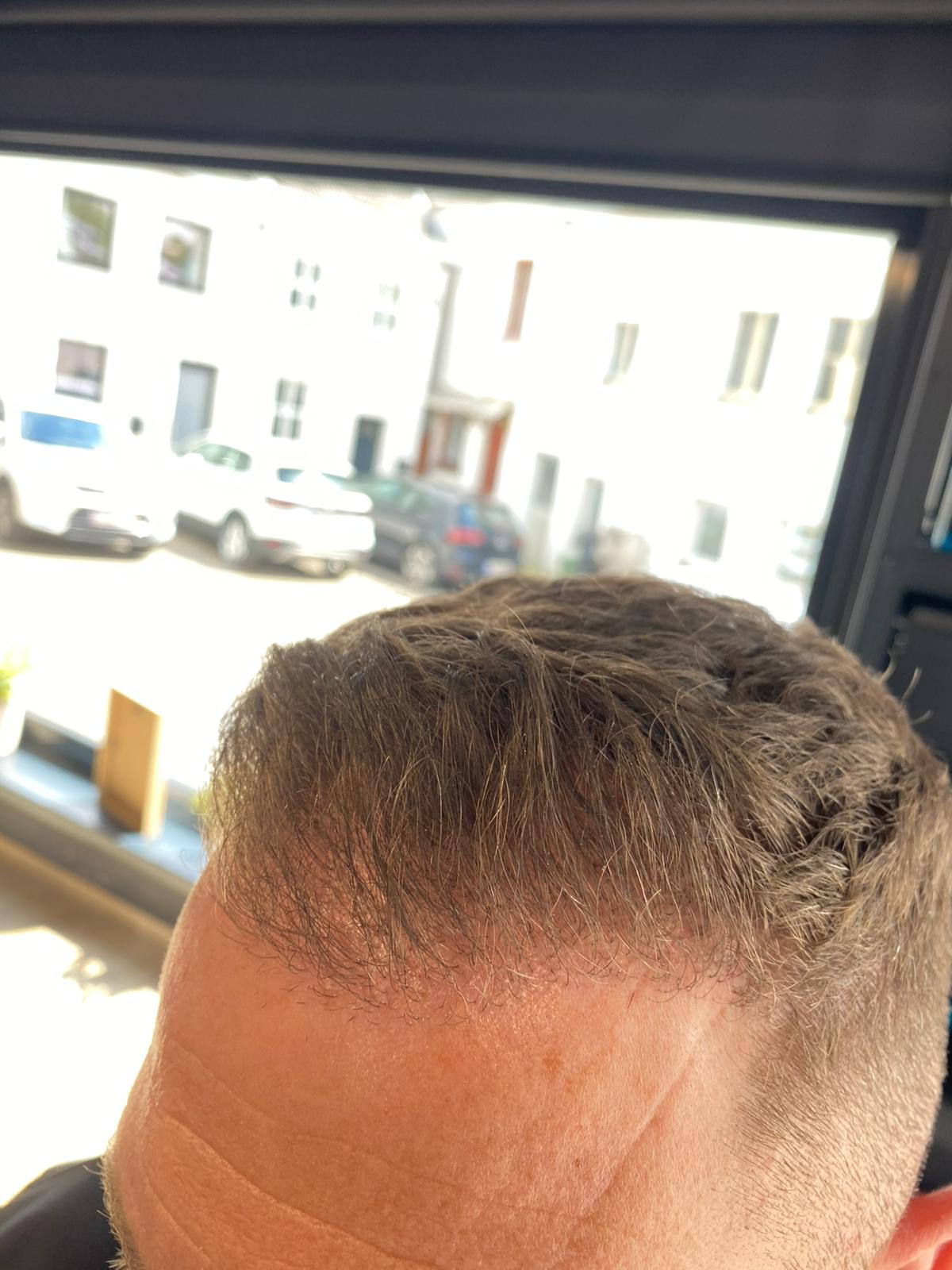 Microneedling capillaire après - ArtFade Lambermont