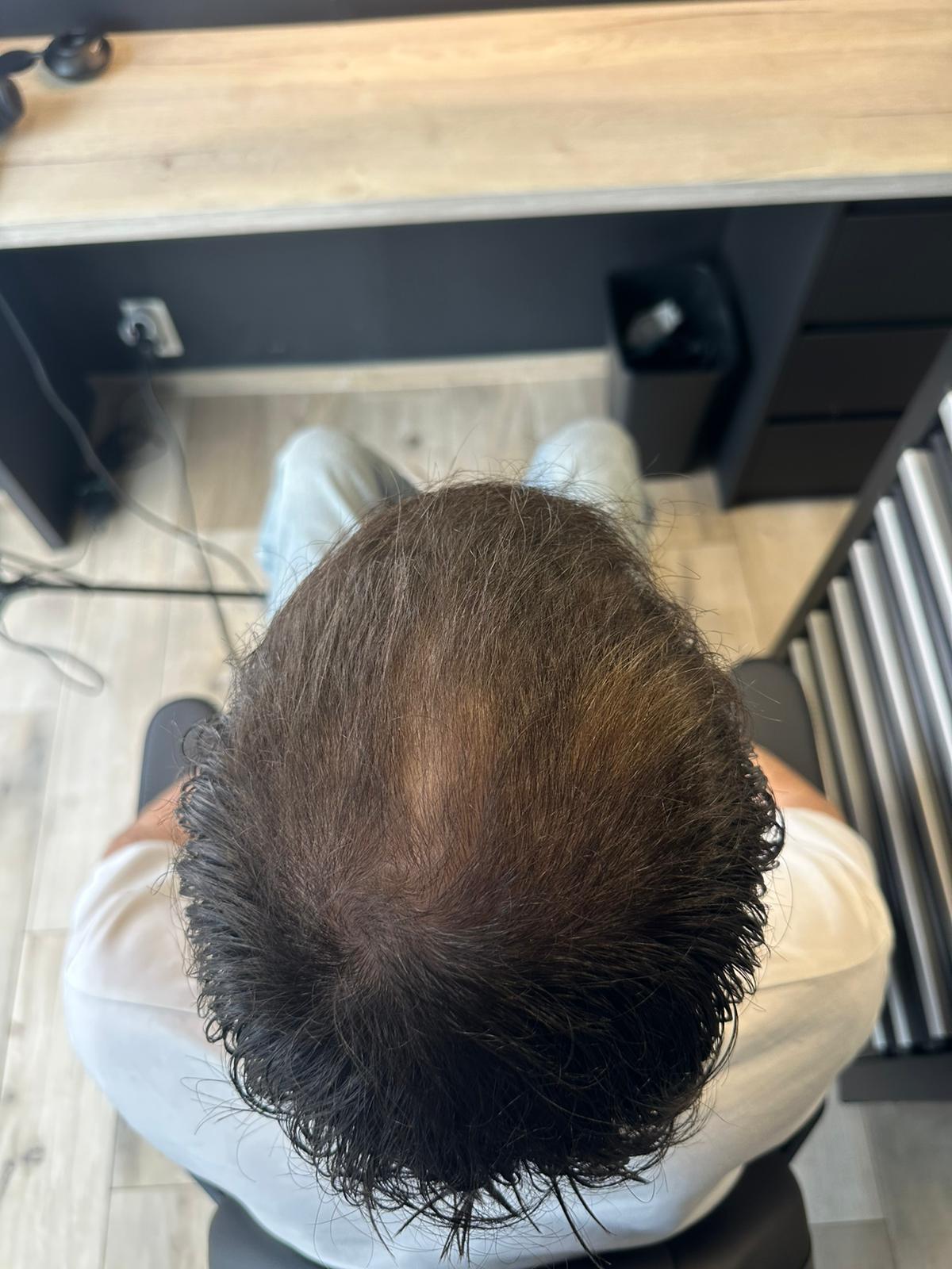 Microneedling capillaire après - ArtFade Lambermont