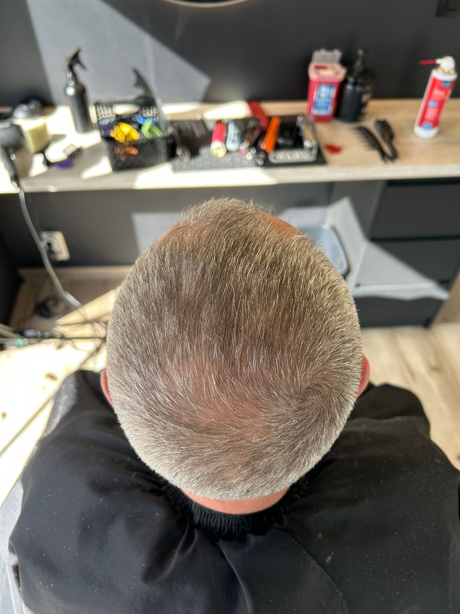 Microneedling capillaire après - ArtFade Lambermont